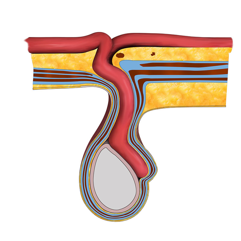 Indirect Inguinal Hernia Treatment London